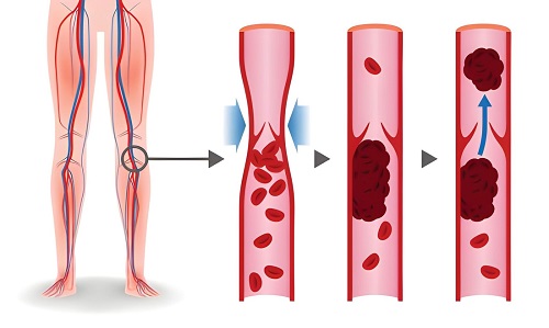 Best Deep Vein Thrombosis Treatment in Andheri, Mumbai